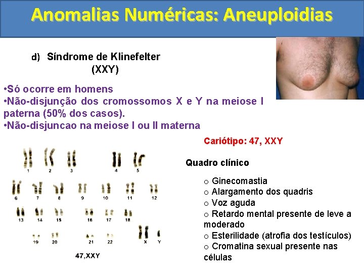 Anomalias Numéricas: Aneuploidias d) Síndrome de Klinefelter (XXY) • Só ocorre em homens •