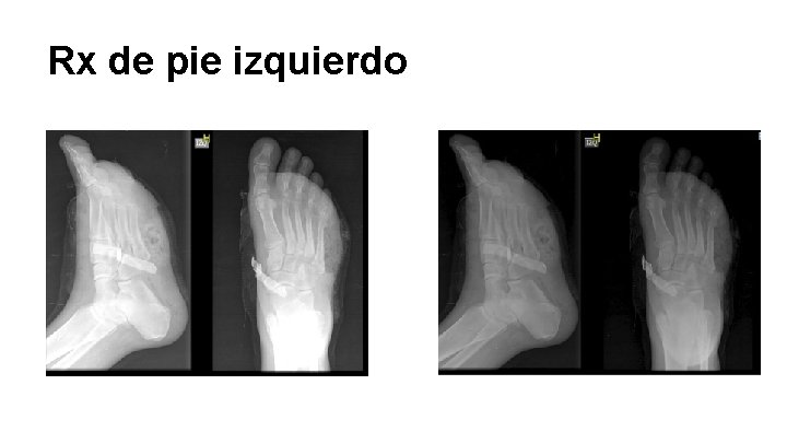 Rx de pie izquierdo 