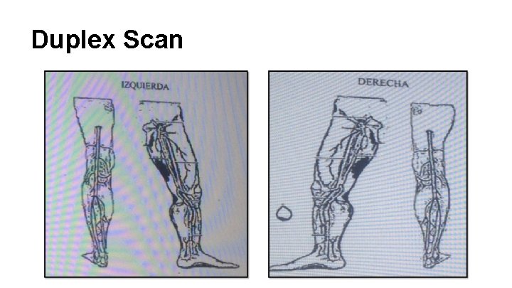 Duplex Scan 