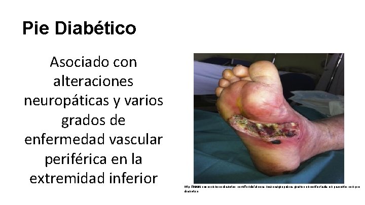 Pie Diabético Asociado con alteraciones neuropáticas y varios grados de enfermedad vascular periférica en