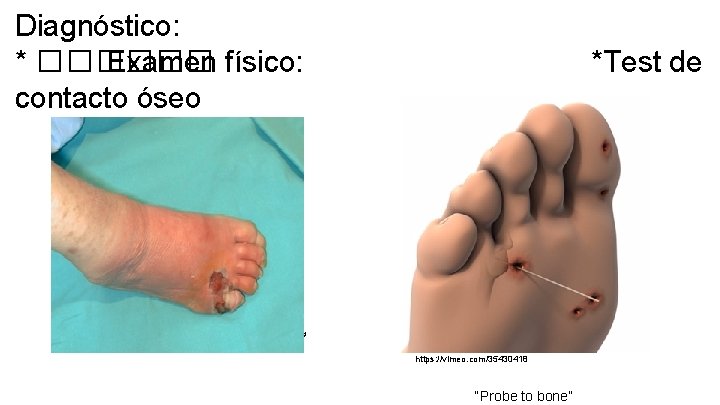 Diagnóstico: * ������ Examen físico: contacto óseo *Test de http: //www. piediabetico. net/imagenes/info_profesional/enfoque_actual/figura 10.
