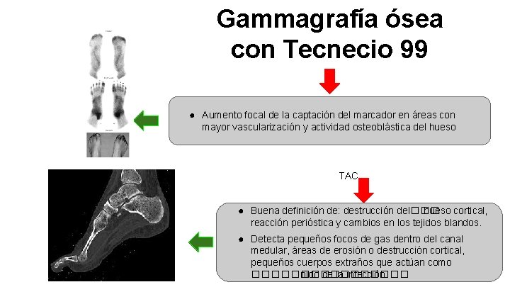 Gammagrafía ósea con Tecnecio 99 ● Aumento focal de la captación del marcador en