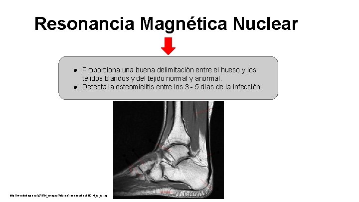 Resonancia Magnética Nuclear ● Proporciona una buena delimitación entre el hueso y los tejidos