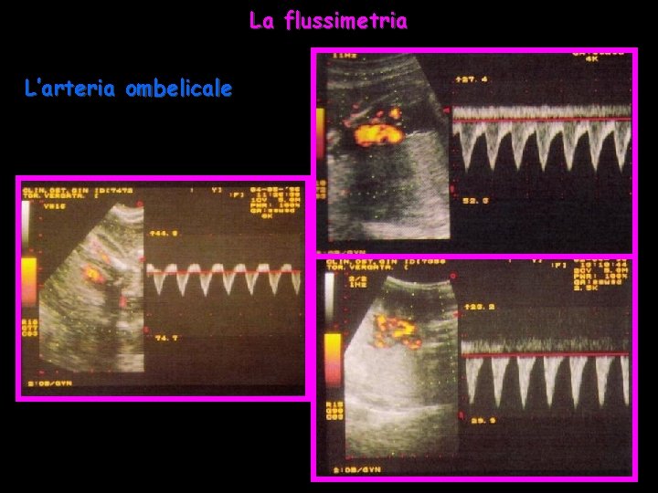 La flussimetria L’arteria ombelicale 