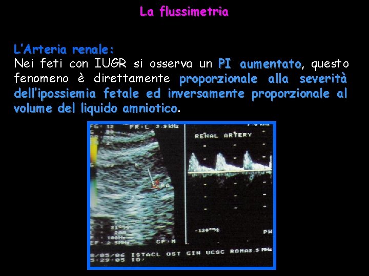 La flussimetria L’Arteria renale: Nei feti con IUGR si osserva un PI aumentato, aumentato