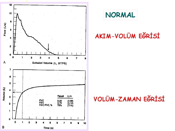 NORMAL AKIM-VOLÜM EĞRİSİ VOLÜM-ZAMAN EĞRİSİ 