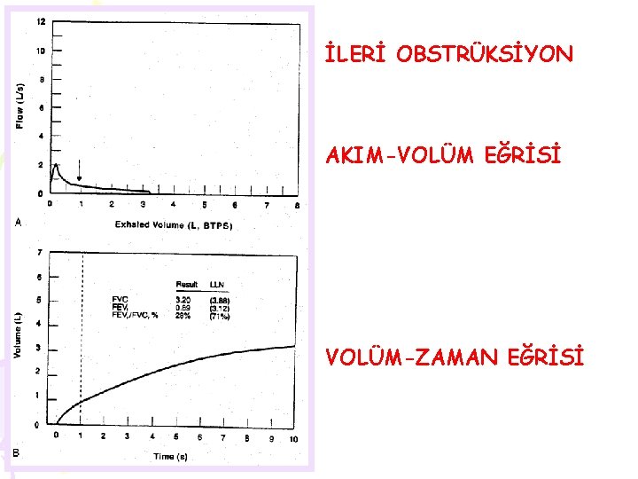 İLERİ OBSTRÜKSİYON AKIM-VOLÜM EĞRİSİ VOLÜM-ZAMAN EĞRİSİ 