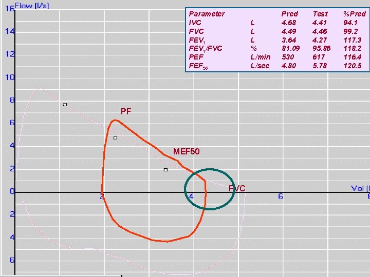 Parameter IVC FEV 1/FVC PEF FEF 50 L L L % L/min L/sec PF