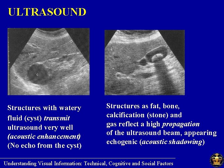 ULTRASOUND Structures as fat, bone, Structures with watery calcification (stone) and fluid (cyst) transmit