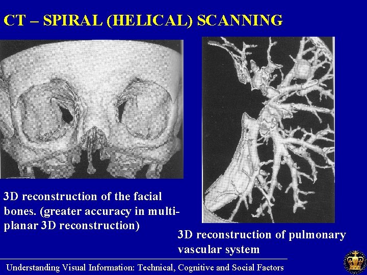 CT – SPIRAL (HELICAL) SCANNING 3 D reconstruction of the facial bones. (greater accuracy