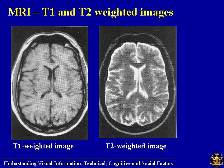 MRI – T 1 and T 2 weighted images T 1 -weighted image T