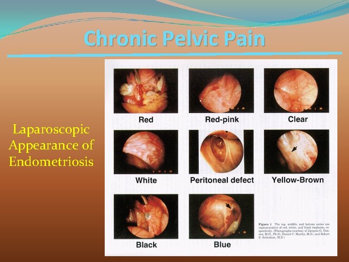 Chronic Pelvic Pain Laparoscopic Appearance of Endometriosis 