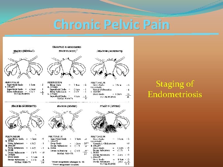 Chronic Pelvic Pain Staging of Endometriosis 