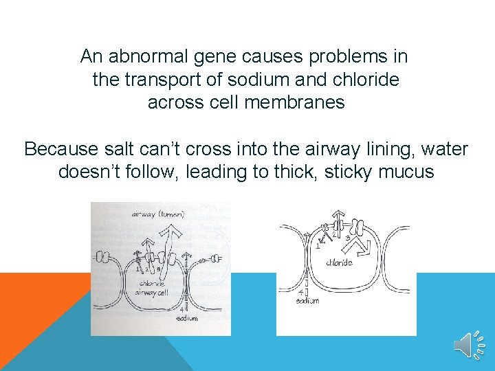 An abnormal gene causes problems in the transport of sodium and chloride across cell