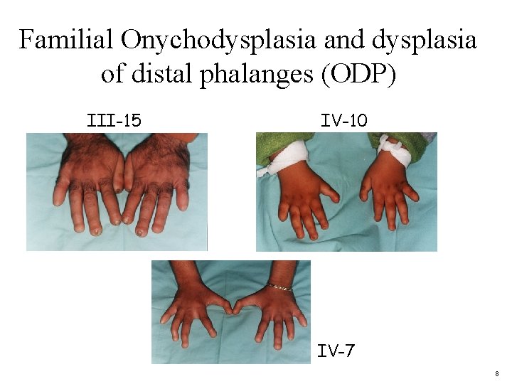 Familial Onychodysplasia and dysplasia of distal phalanges (ODP) III-15 IV-10 IV-7 8 