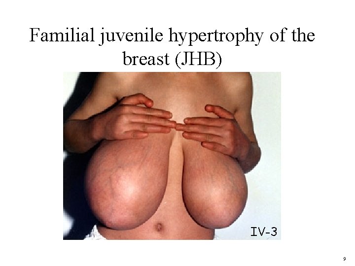 Familial juvenile hypertrophy of the breast (JHB) IV-3 9 