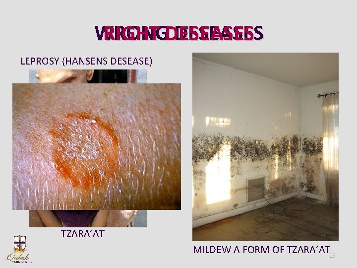 WRONG DESEASES RIGHT DESEASES LEPROSY (HANSENS DESEASE) PSORIASIS TZARA’AT MILDEW A FORM OF TZARA’AT