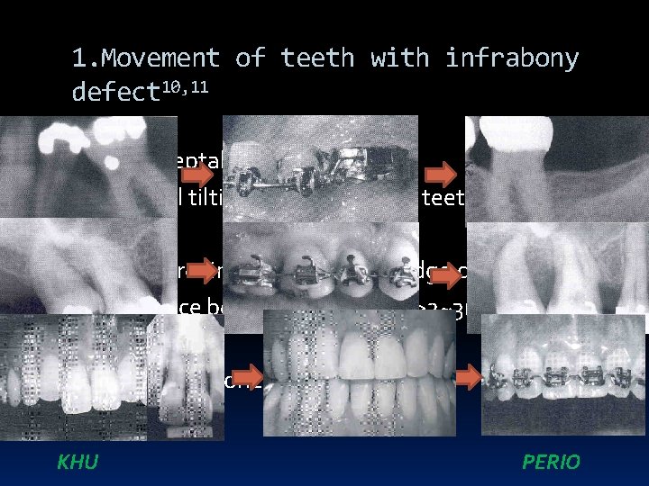 1. Movement of teeth with infrabony defect 10, 11 1) Hemiseptal Defects - mesial