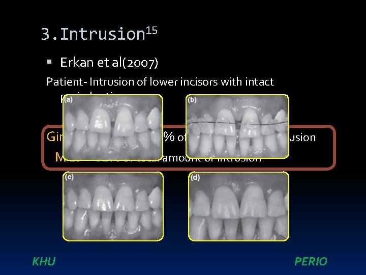 3. Intrusion 15 Erkan et al(2007) Patient- Intrusion of lower incisors with intact periodontium