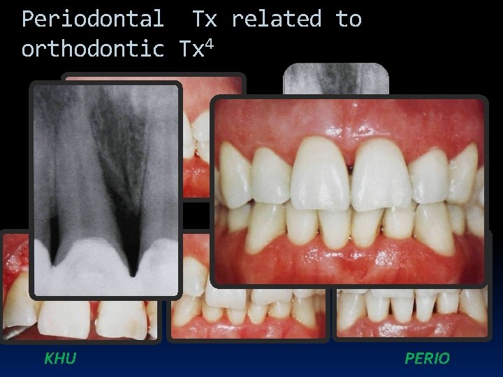 Periodontal Tx related to orthodontic Tx 4 KHU PERIO 