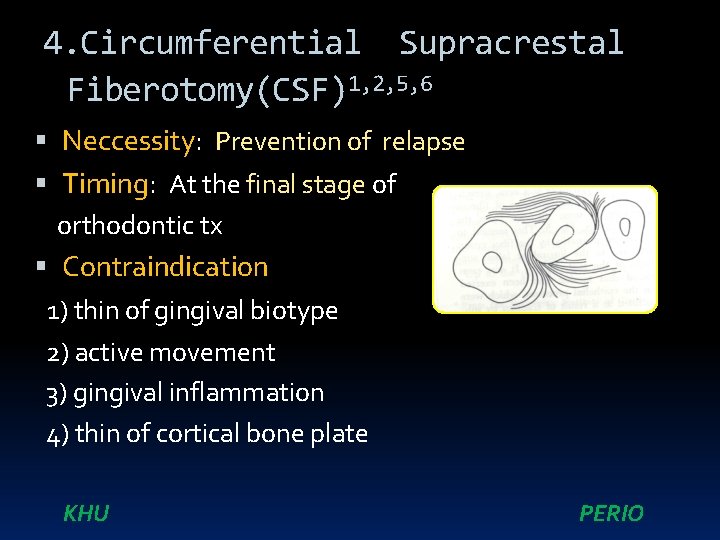4. Circumferential Supracrestal Fiberotomy(CSF)1, 2, 5, 6 Neccessity: Prevention of relapse Timing: At the