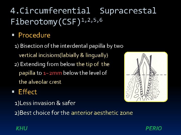 4. Circumferential Supracrestal Fiberotomy(CSF)1, 2, 5, 6 Procedure 1) Bisection of the interdental papilla