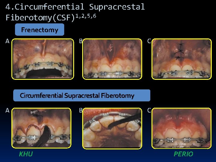 4. Circumferential Supracrestal Fiberotomy(CSF)1, 2, 5, 6 Frenectomy A B C Circumferential Supracrestal Fiberotomy