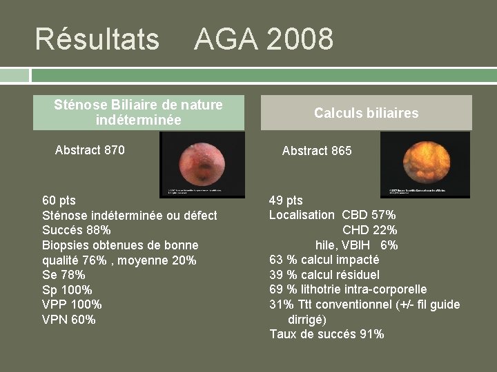 Résultats AGA 2008 Sténose Biliaire de nature indéterminée Abstract 870 60 pts Sténose indéterminée