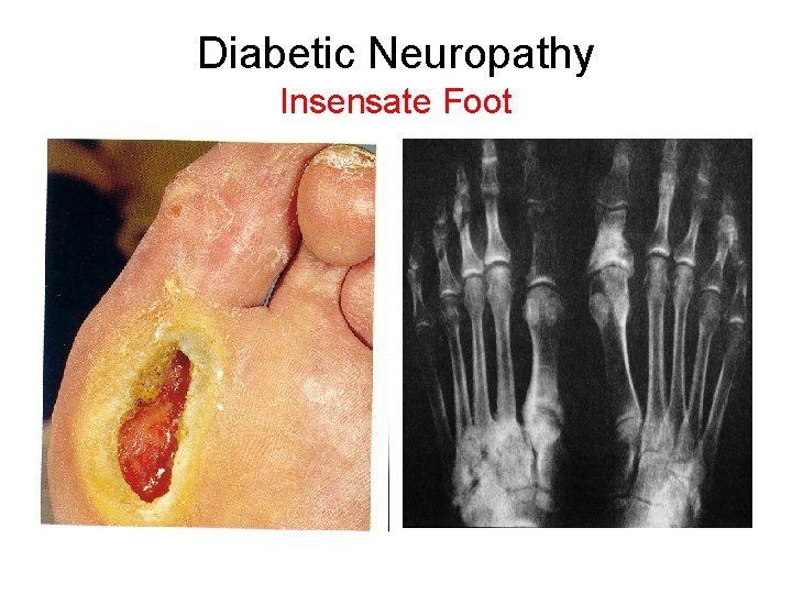 Diabetic Neuropathy Insensate Foot 