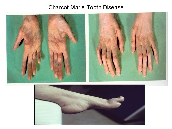 Charcot-Marie-Tooth Disease 