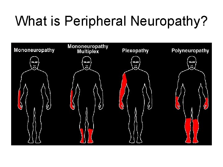 What is Peripheral Neuropathy? 