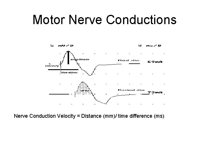 Motor Nerve Conductions Nerve Conduction Velocity = Distance (mm)/ time difference (ms) 
