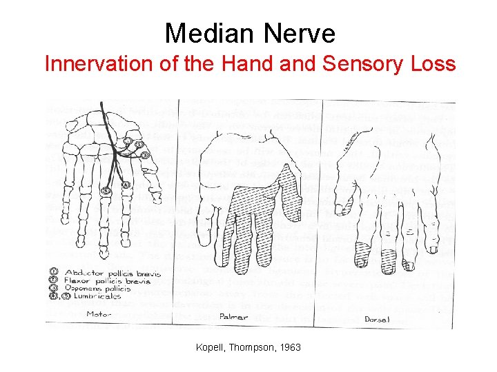 Median Nerve Innervation of the Hand Sensory Loss Kopell, Thompson, 1963 