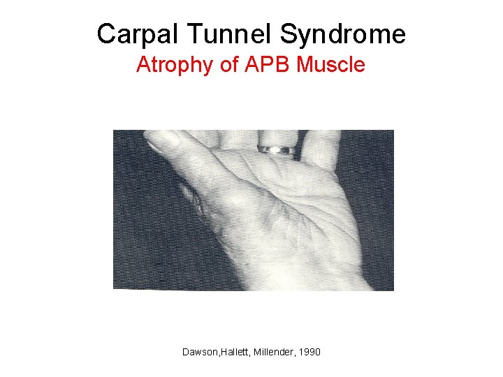 Carpal Tunnel Syndrome Atrophy of APB Muscle Dawson, Hallett, Millender, 1990 