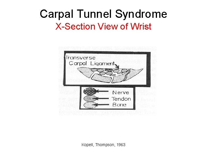 Carpal Tunnel Syndrome X-Section View of Wrist Kopell, Thompson, 1963 