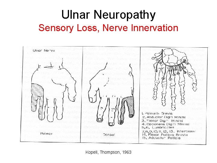 Ulnar Neuropathy Sensory Loss, Nerve Innervation Kopell, Thompson, 1963 