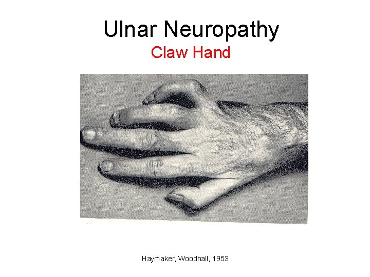 Ulnar Neuropathy Claw Hand Haymaker, Woodhall, 1953 