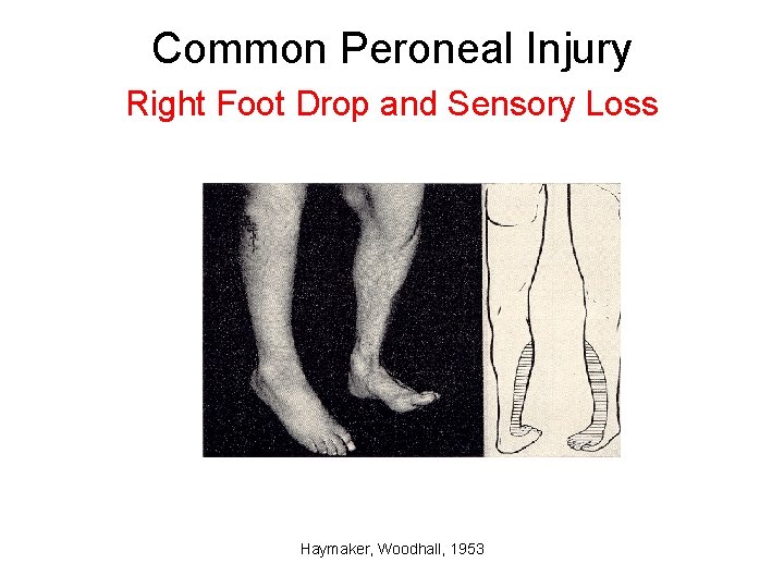 Common Peroneal Injury Right Foot Drop and Sensory Loss Haymaker, Woodhall, 1953 