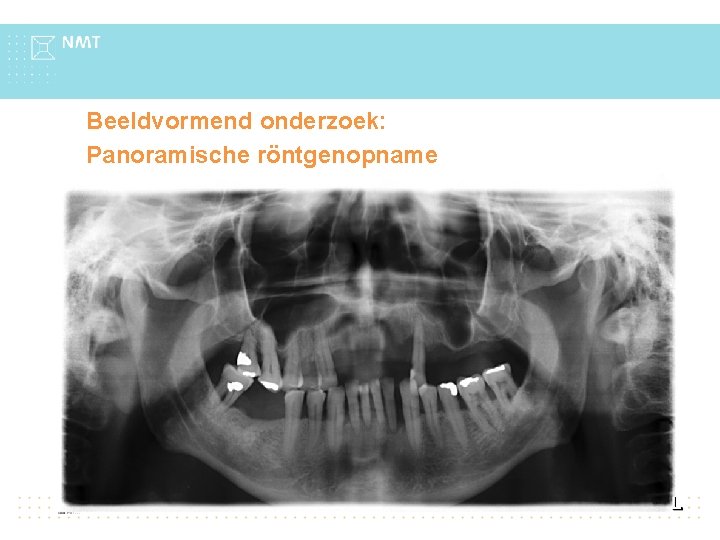 Beeldvormend onderzoek: Panoramische röntgenopname Bevindingen: Dentinecariës in de 14 en de 46 Terug naar