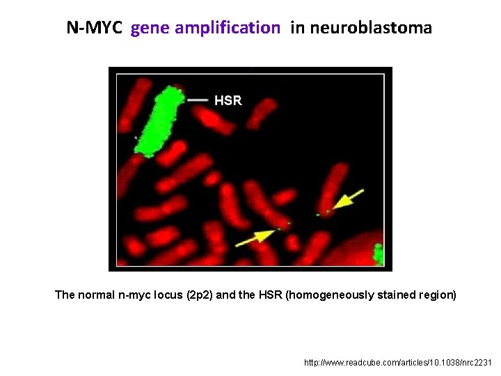 N-MYC gene amplification in neuroblastoma The normal n-myc locus (2 p 2) and the