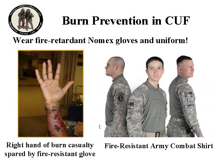 Burn Prevention in CUF Wear fire-retardant Nomex gloves and uniform! Right hand of burn