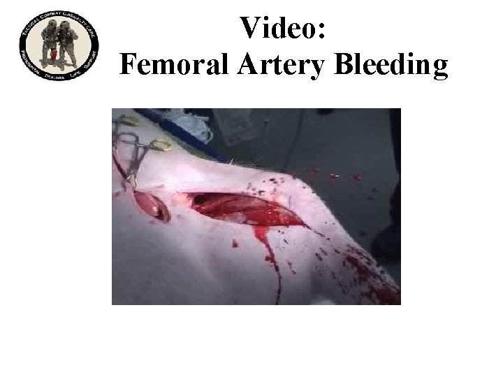 Video: Femoral Artery Bleeding 