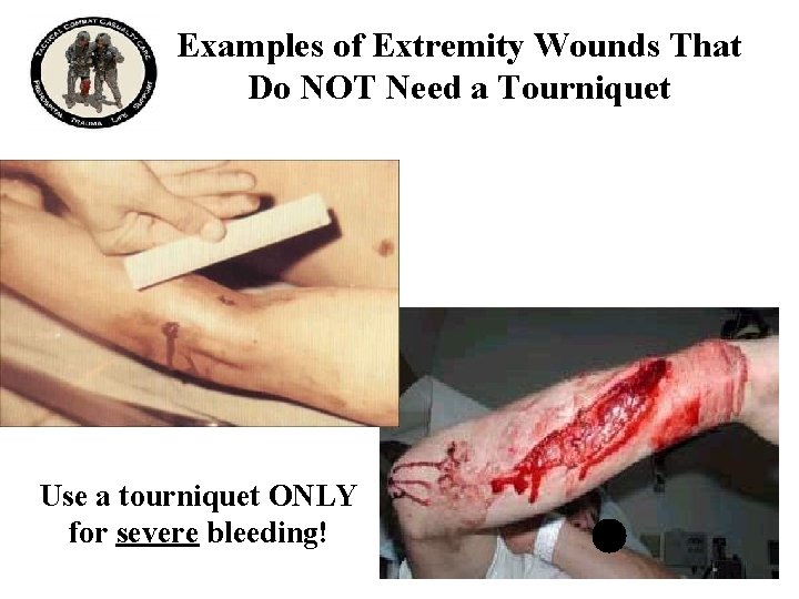 Examples of Extremity Wounds That Do NOT Need a Tourniquet Use a tourniquet ONLY