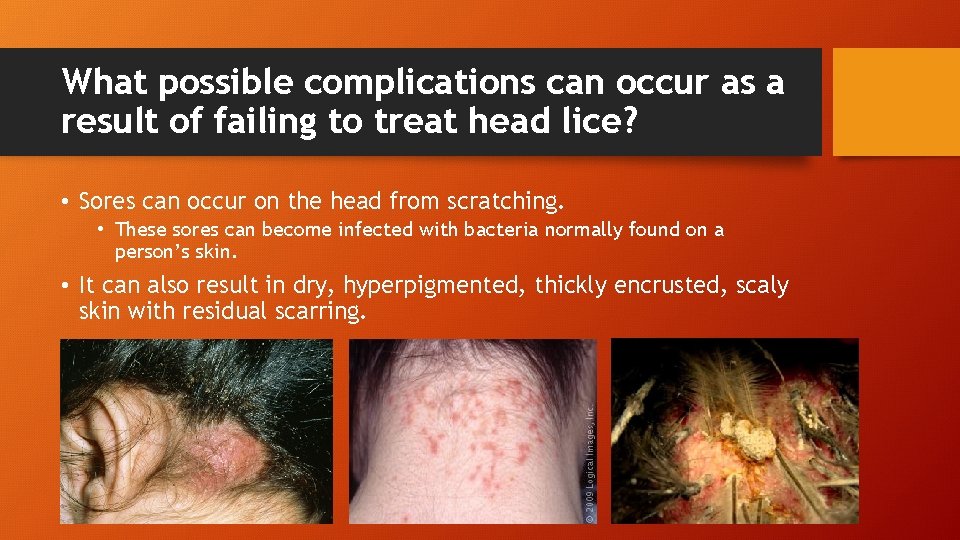 What possible complications can occur as a result of failing to treat head lice?
