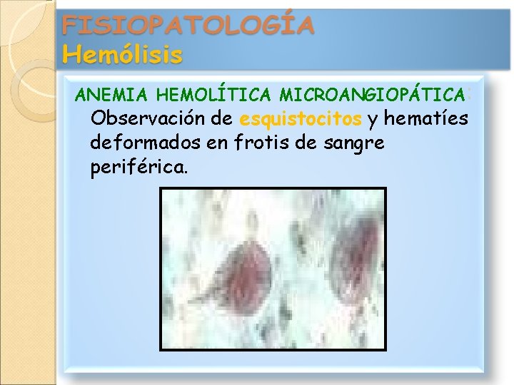 ANEMIA HEMOLÍTICA MICROANGIOPÁTICA: Observación de esquistocitos y hematíes deformados en frotis de sangre periférica.