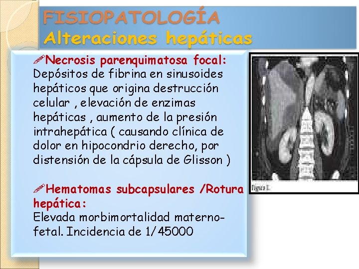  Necrosis parenquimatosa focal: Depósitos de fibrina en sinusoides hepáticos que origina destrucción celular