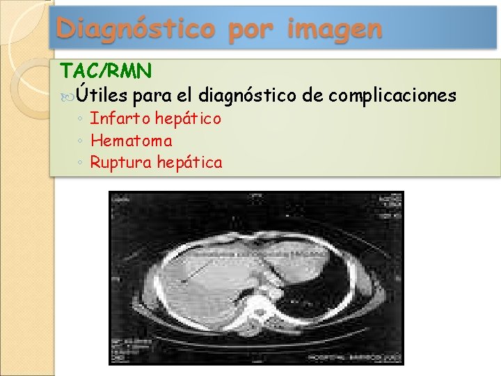 TAC/RMN Útiles para el diagnóstico de complicaciones ◦ Infarto hepático ◦ Hematoma ◦ Ruptura