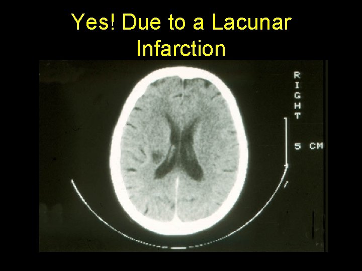 Yes! Due to a Lacunar Infarction 