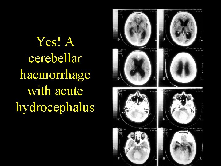 Yes! A cerebellar haemorrhage with acute hydrocephalus 