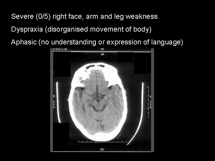 Severe (0/5) right face, arm and leg weakness Dyspraxia (disorganised movement of body) Aphasic
